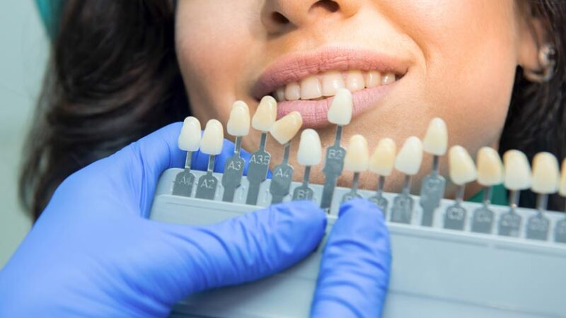 Tannbleking er rimeligere på nett