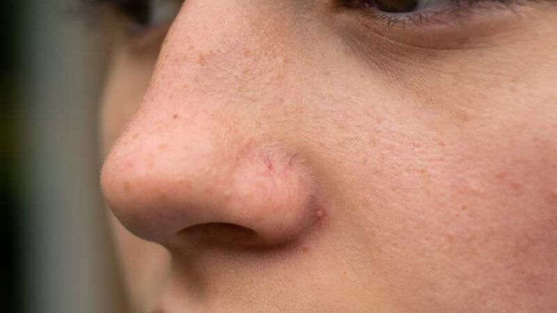 En guide til å forstå rosacea